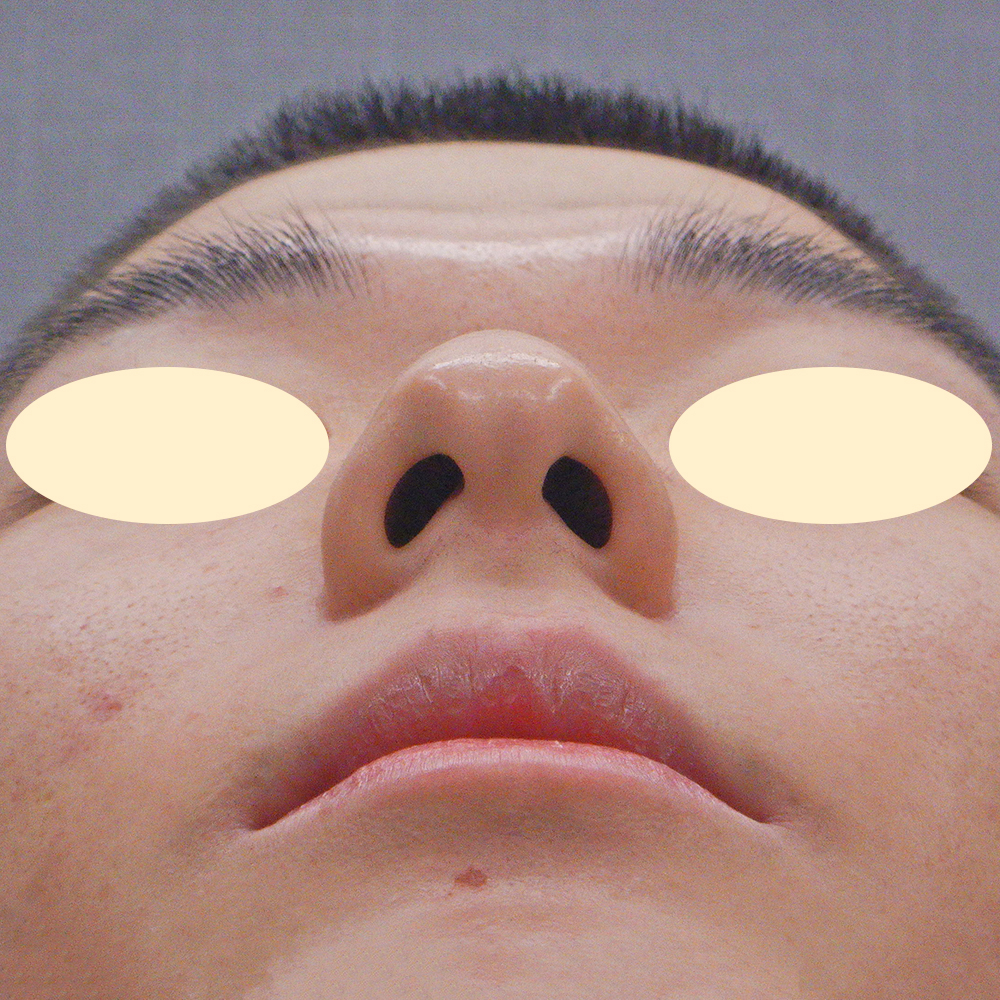 施術前正面