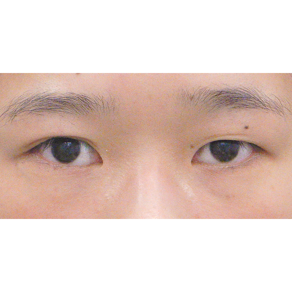 施術前正面