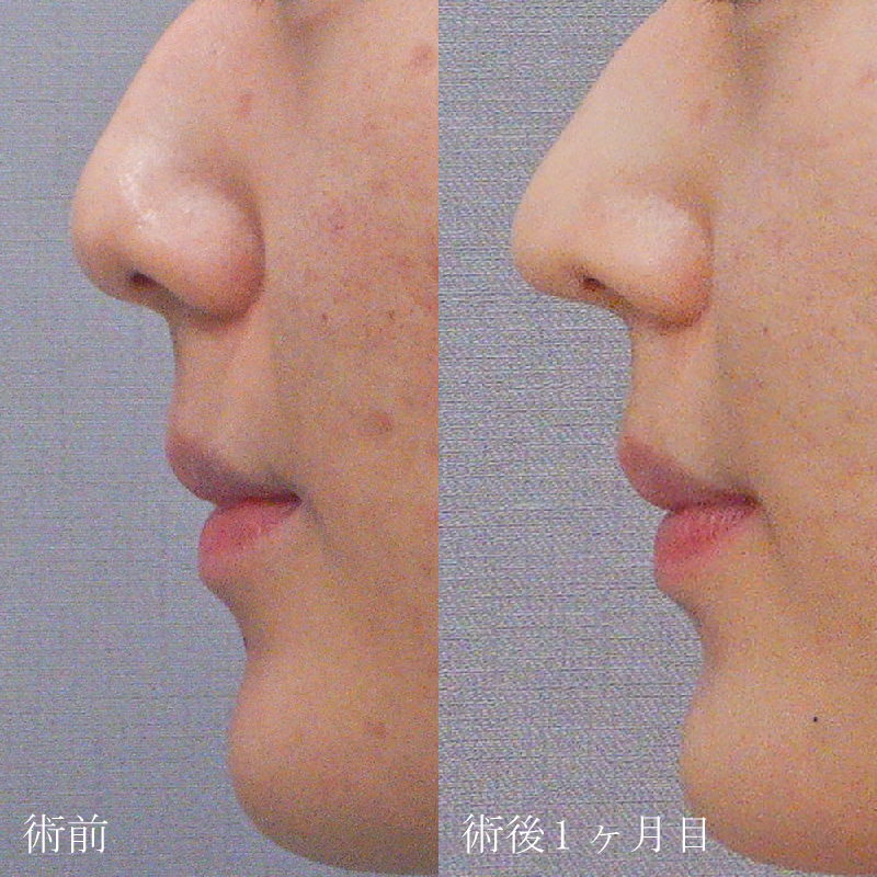 鼻尖耳介_2022.7.29_津田