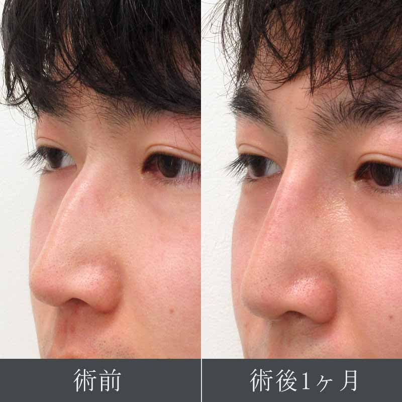 鼻のプロテーゼ 症例1