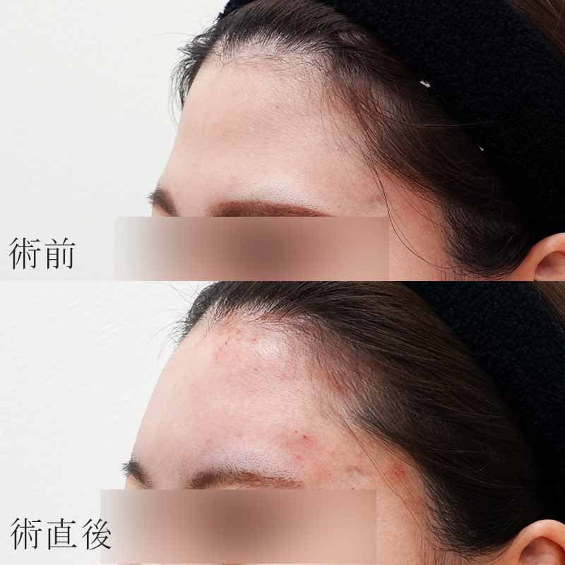 心斎橋院 院長金子医師の額のヒアルロン酸症例写真