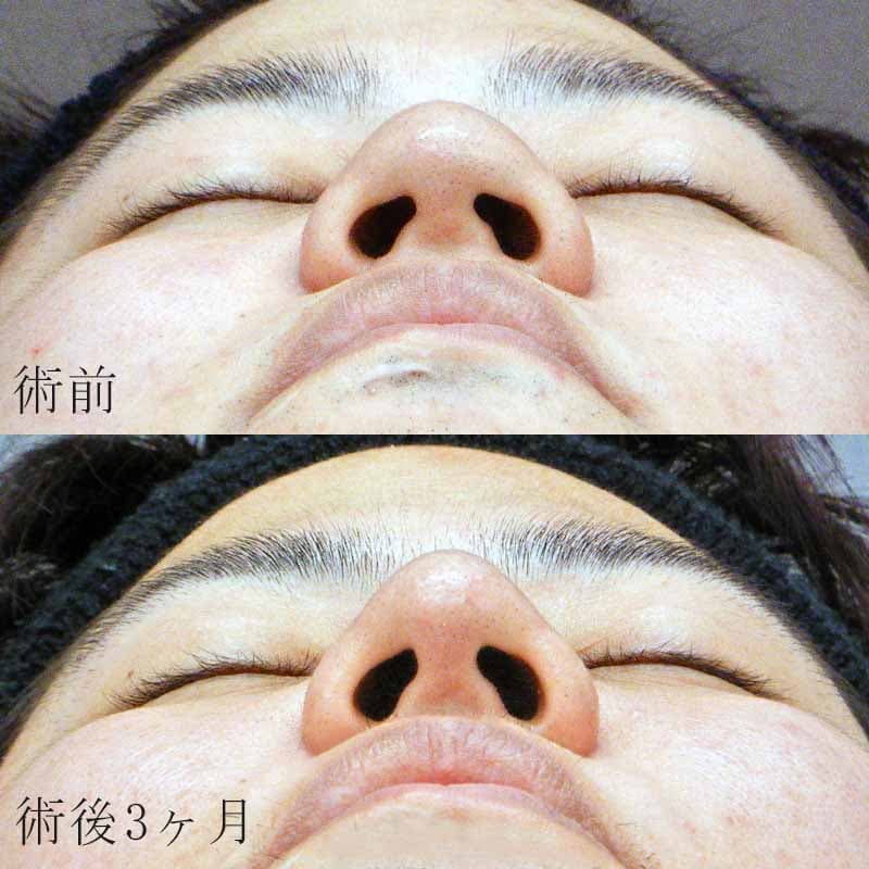 O-16872 津田Dr 鼻尖縮小・耳介軟骨移植