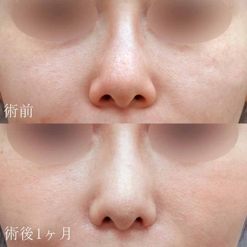 小鼻縮小 症例1