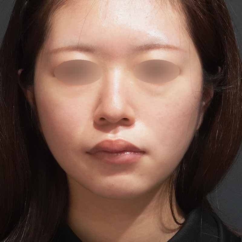 20230530_N40123_suzuki_face-liposuction_O_part_After