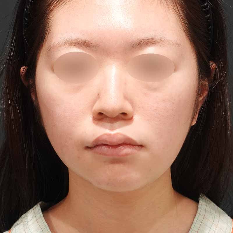 20230530_N40123_suzuki_face-liposuction_O_part_Before