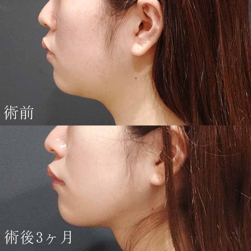 20230530_N40123_suzuki_face-liposuction_O_part_TOP