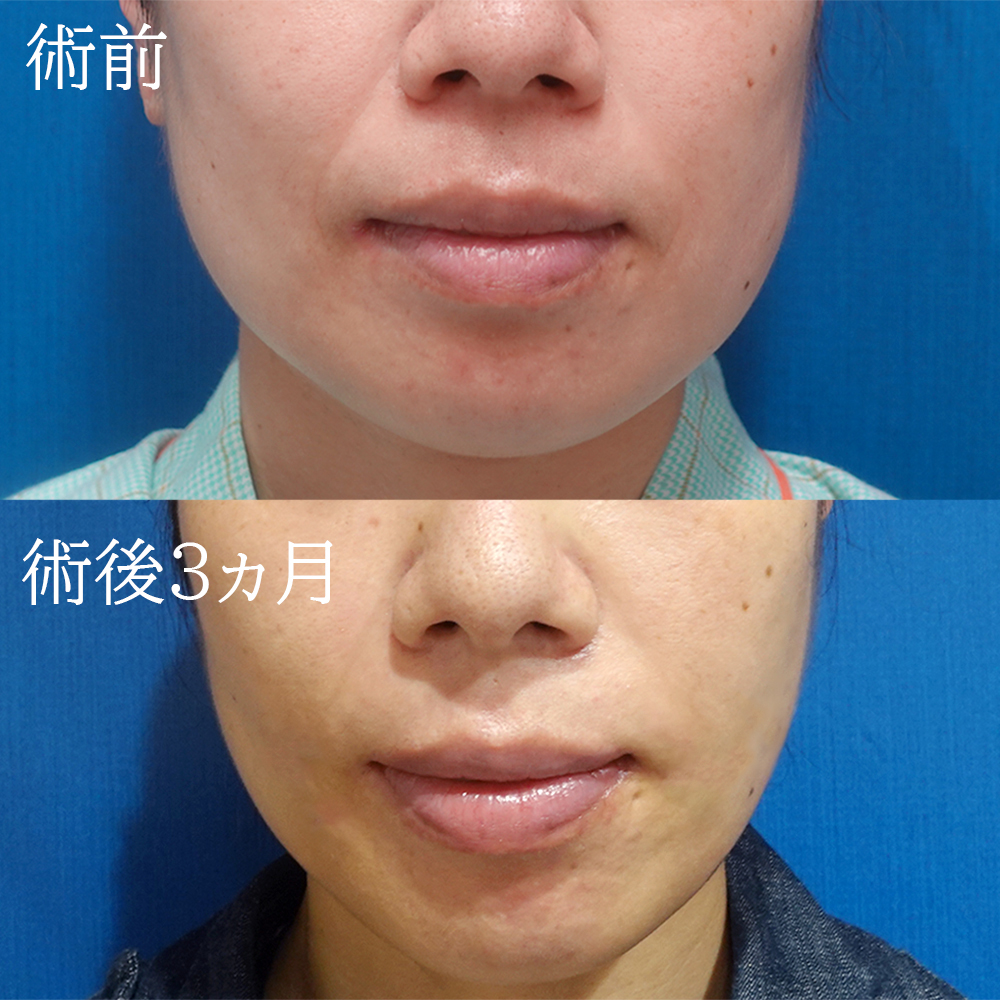 face-liposuction-ishihara20230529