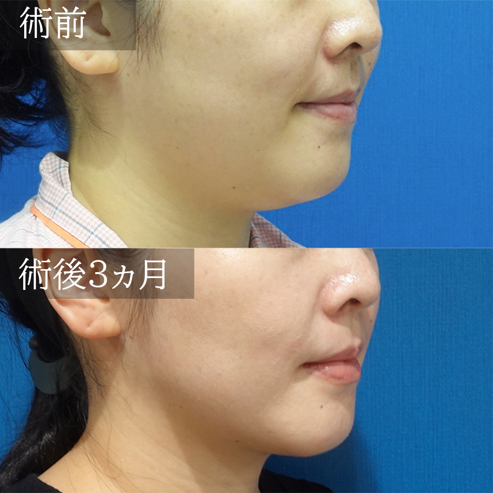 face-liposuction-photo-furumura0529