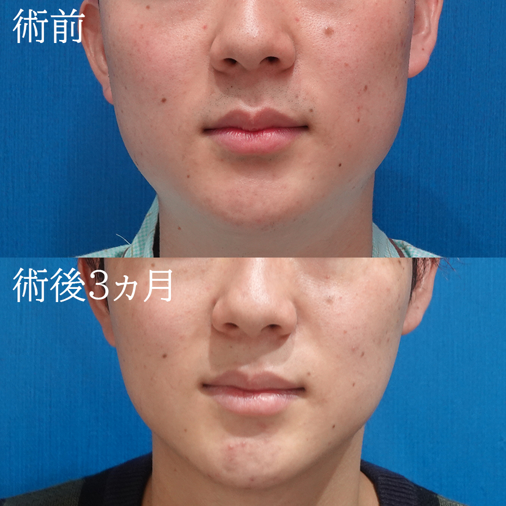 face-loposuction-men-furumura20230529