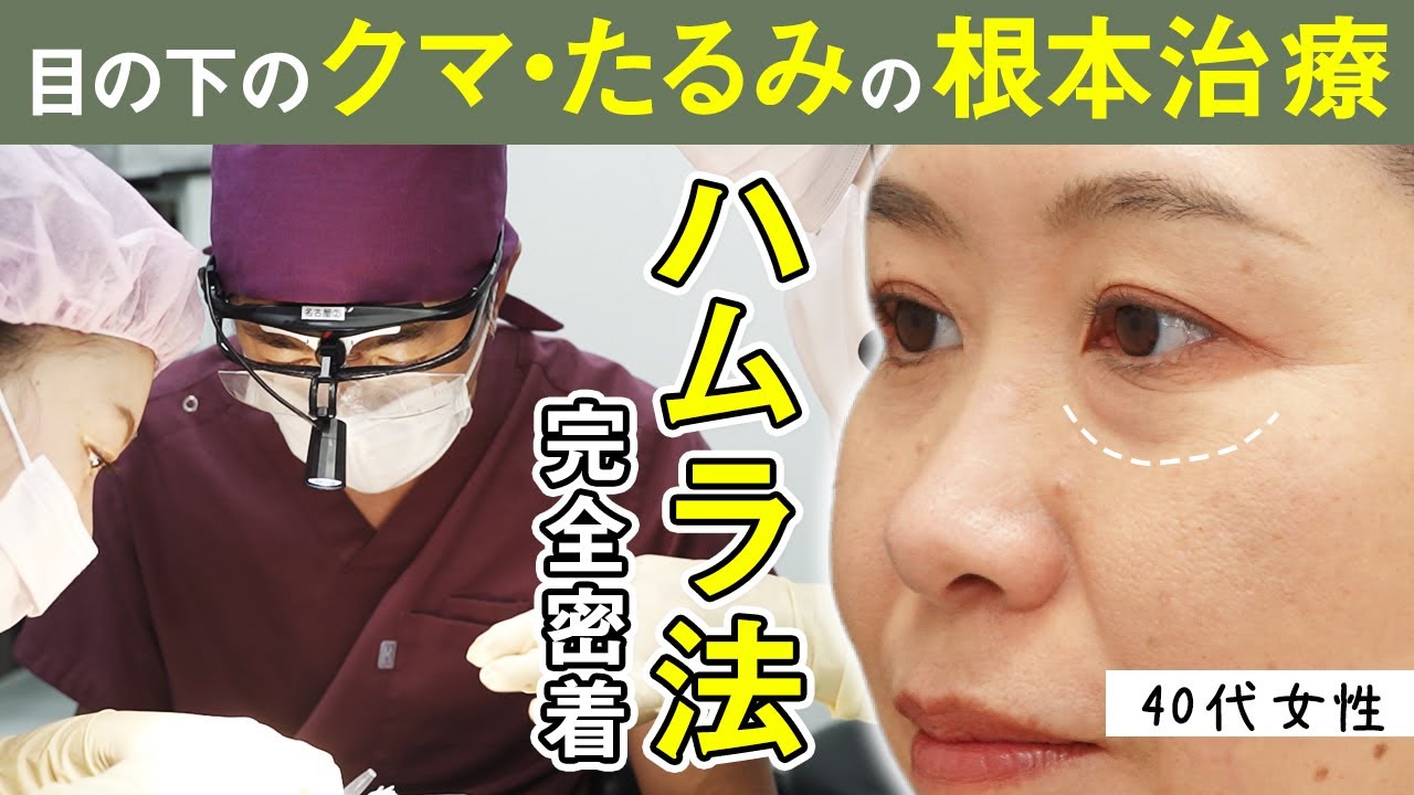 【若返り】目の下のクマ・たるみは「脱脂」だけでは改善できません｜ハムラ法手術〜ダウンタイム3ヶ月まで全部見せます。【40代・50代】