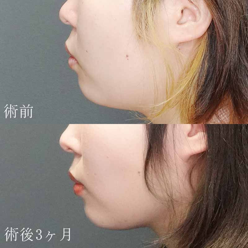 顔（ほほ・顎下）の脂肪吸引の症例写真_東京銀座院竹村医師