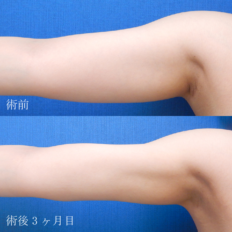 二の腕の脂肪吸引の症例写真_東京銀座院竹村医師