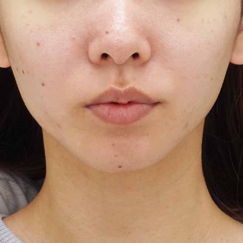 20230608_N28441_kane_face-liposuction_M_part