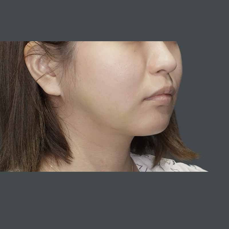 20230619_G26102_ishihara_face-liposuction_M_part3