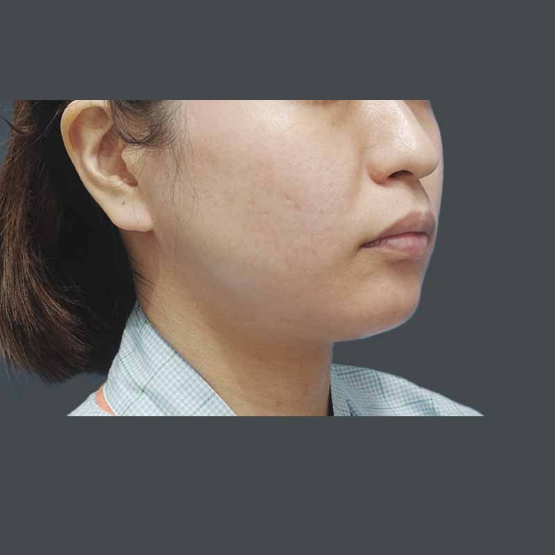 20230619_G26102_ishihara_face-liposuction_M_part2