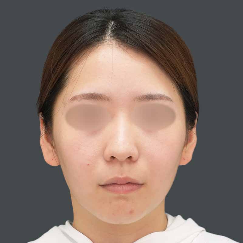 20230711_N38966_kaneko_face-liposuction_M_part