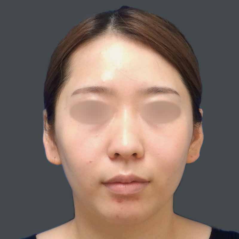 20230711_N38966_kaneko_face-liposuction_M_part