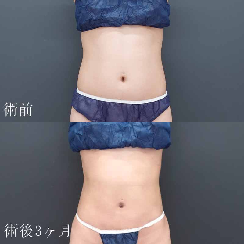 20230726_N23303_sato_stomach-liposuction001