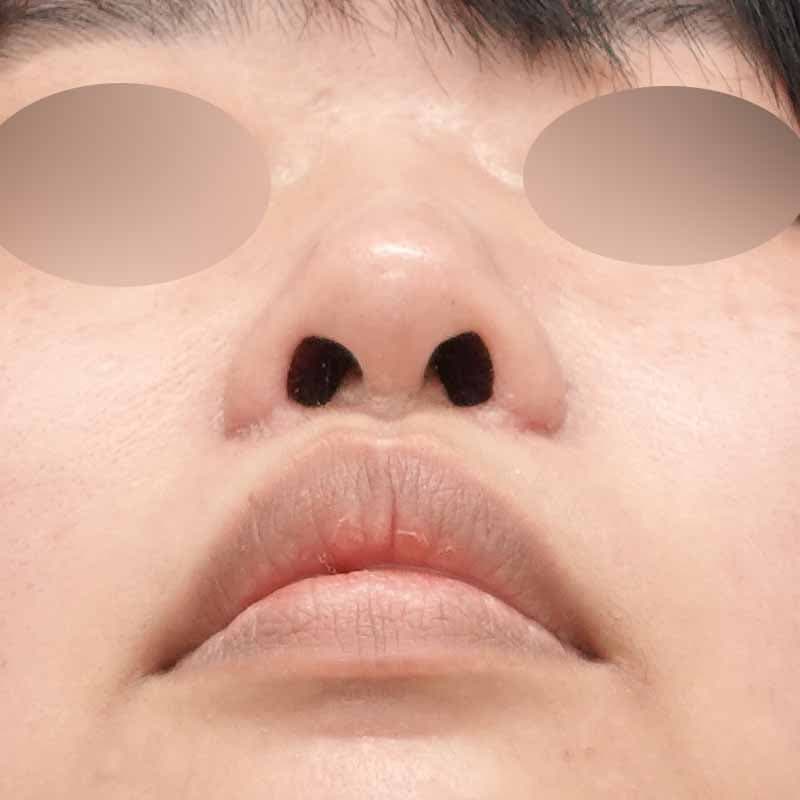 230710_N39795_ishihara_nostril reduction_M_all 