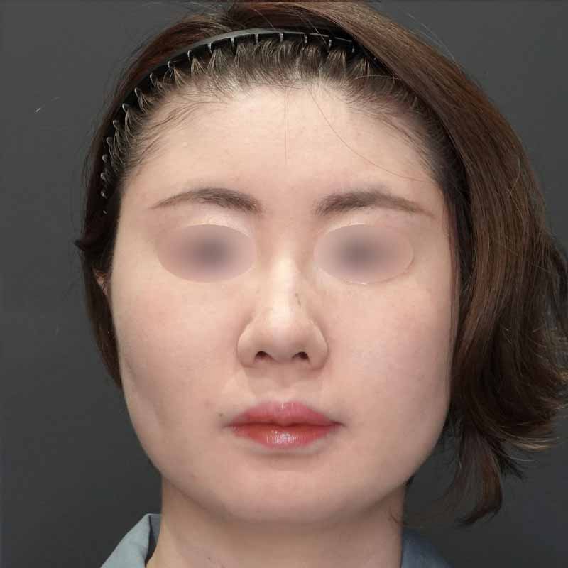20231012_G31871_takemura_face-liposuction_masseter-muscle-botox02①Before1