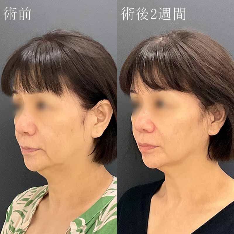 福岡院 院長金子医師のヒアルロン酸リフト症例写真②