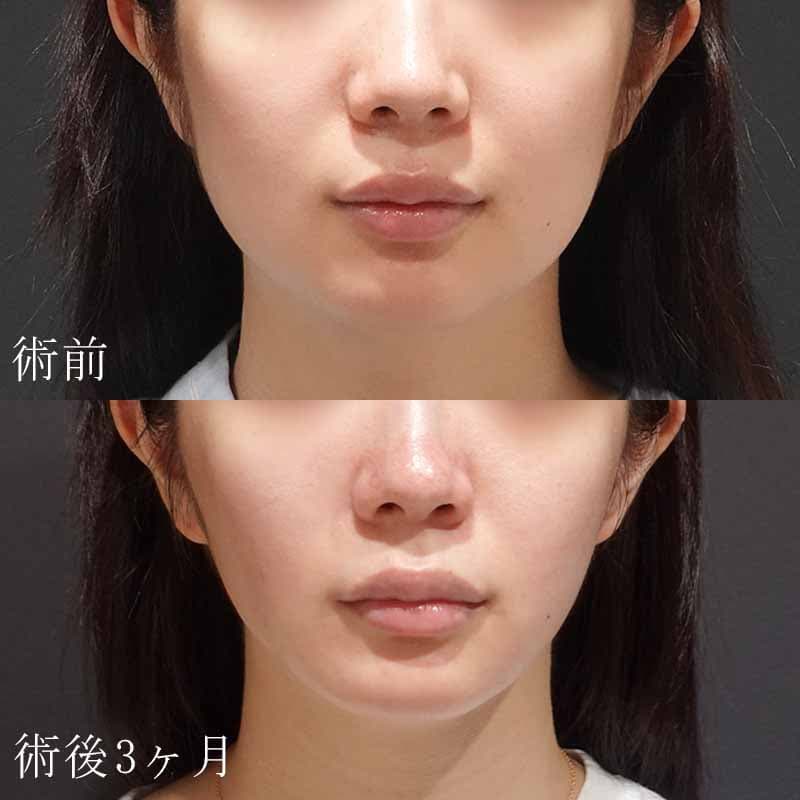 20231026_S24378_hurumura_face-liposuction_masseter-muscle-botox01
