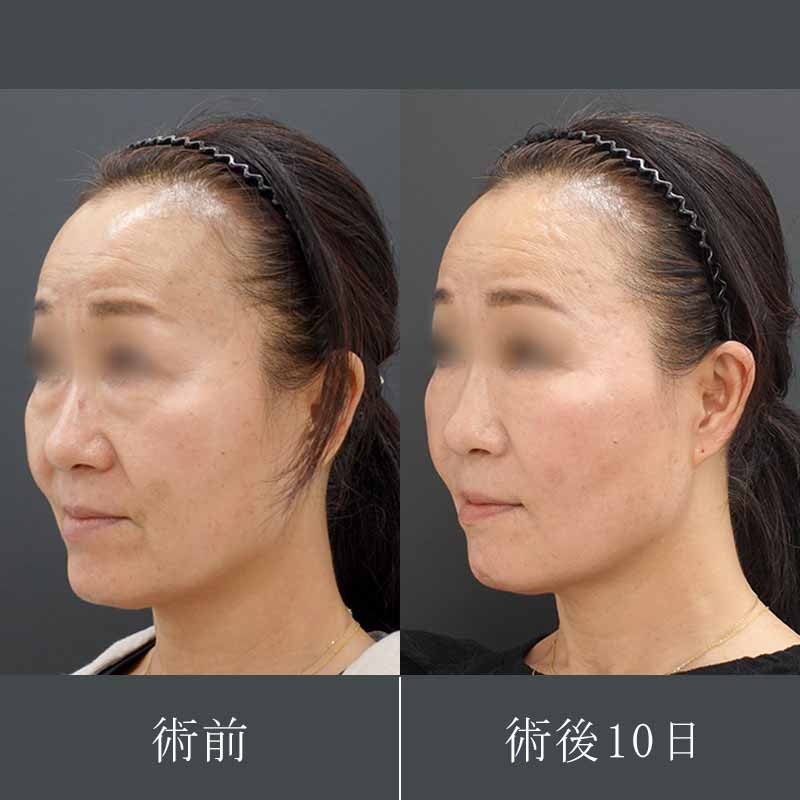 20231031_F-3012_kaneko_hyaluronic acid lift 01＋