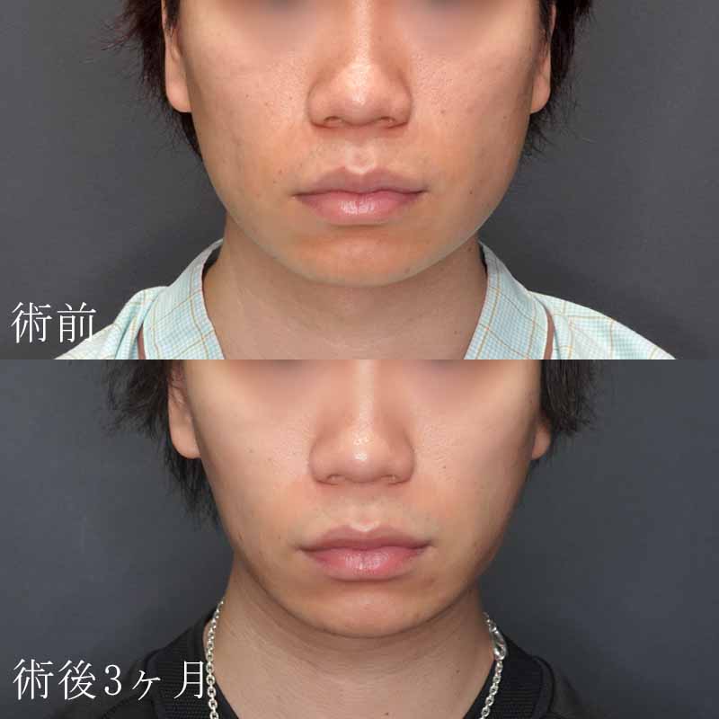 20231101_G32162_isihara_face-liposuction_masseter-muscle-botox01