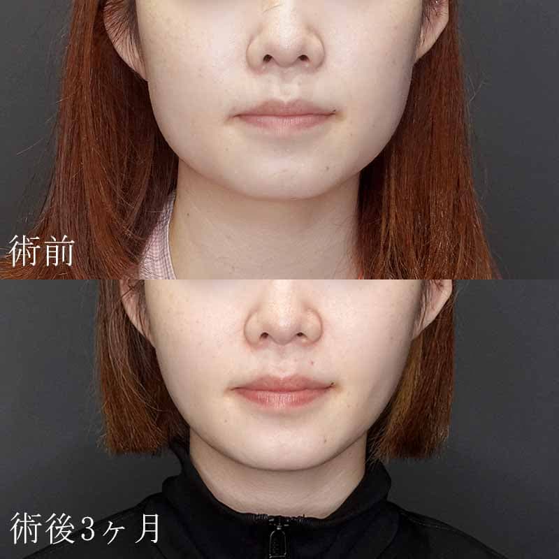 20231109_G32375_takemura_face-liposuction_masseter-muscle-botox01