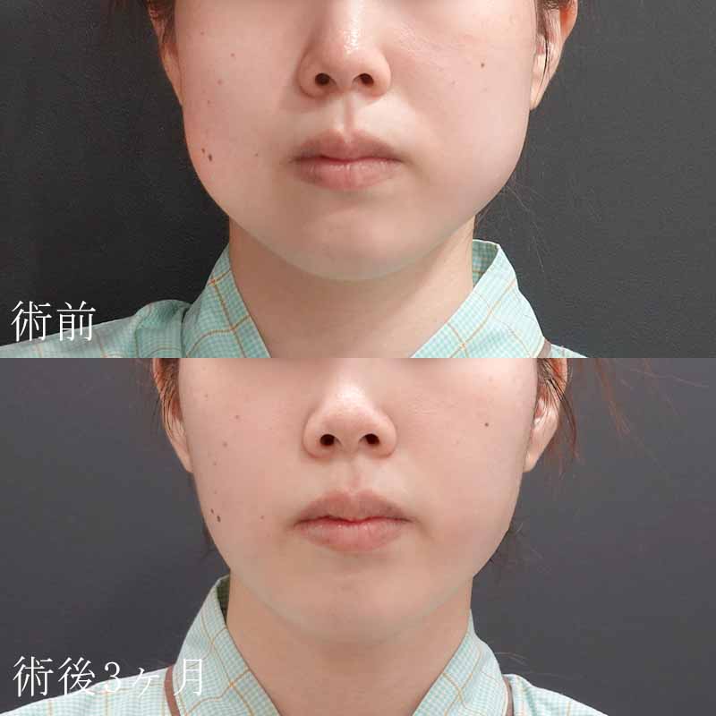 20231114_O-33142_sato_face-liposuction_masseter-muscle-botox01