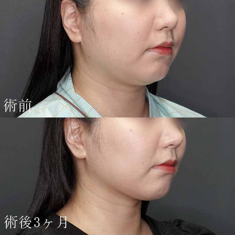 20231123_G31860_isihara_face-liposuction_masseter-muscle-botox01