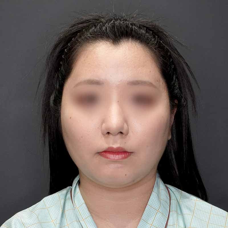 20231123_G31860_isihara_face-liposuction_masseter-muscle-botox02①Before