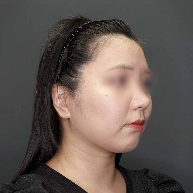 20231123_G31860_isihara_face-liposuction_masseter-muscle-botox02②After