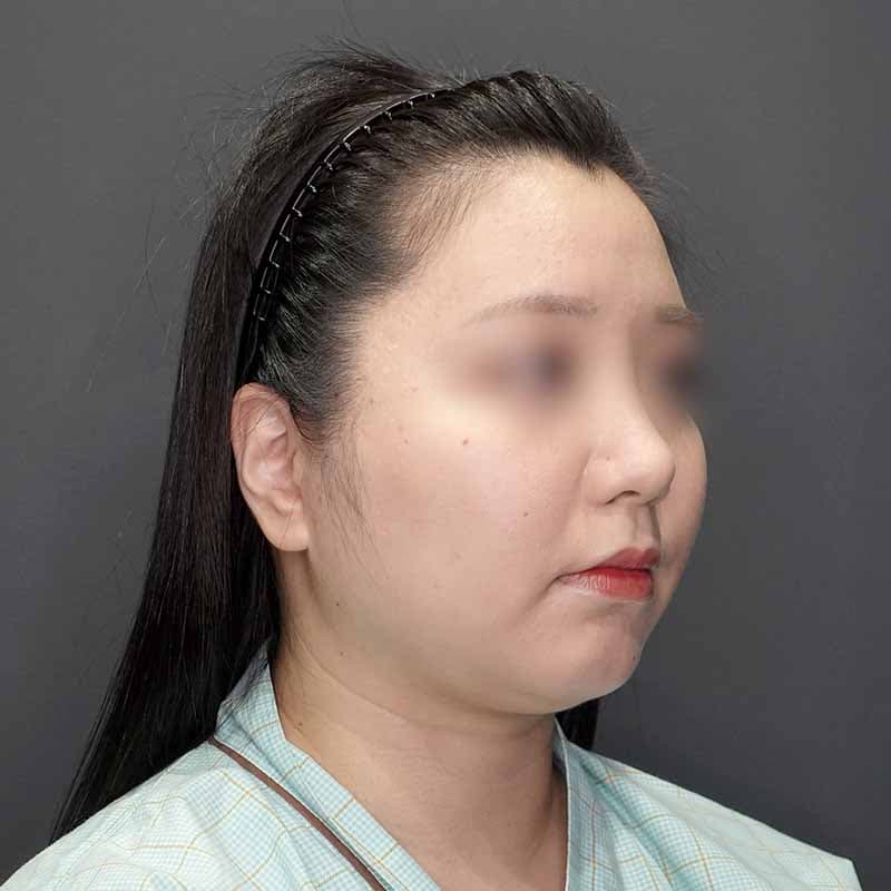 20231123_G31860_isihara_face-liposuction_masseter-muscle-botox02②Before