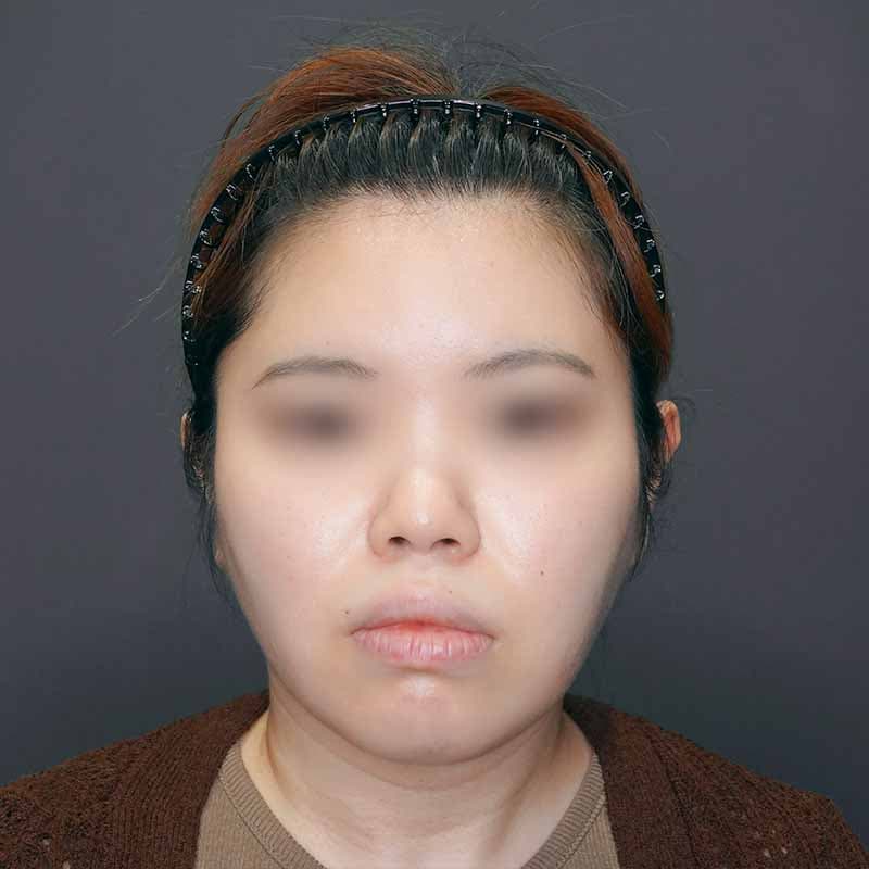 20231128_G32459_isihara_face-liposuction_masseter-muscle-botox02③After