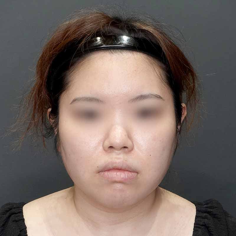 20231128_G32459_isihara_face-liposuction_masseter-muscle-botox02③Before