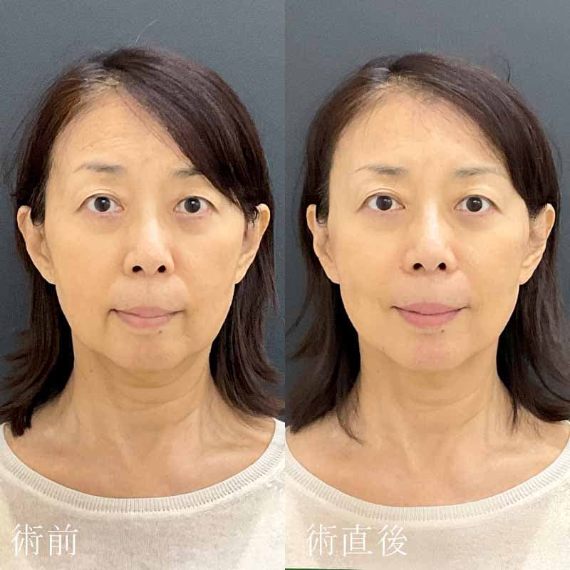 20231129_F-4782_kaneko_hyaluronic acid lift 01