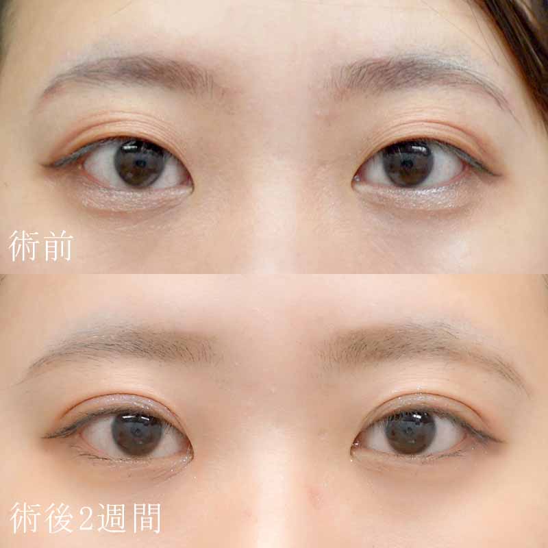 田中医師の二重埋没法の症例写真①