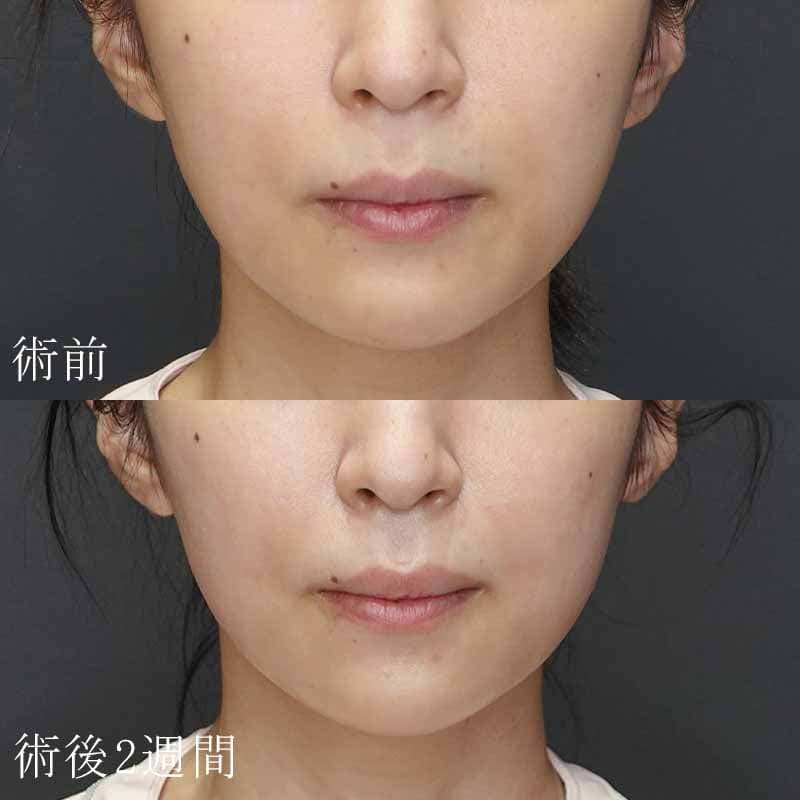 20231218_Gst1218_nakamura_philtrum-botox