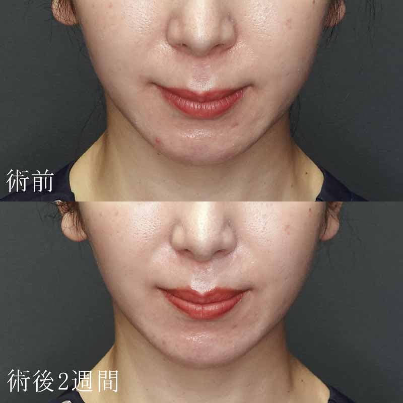 20231218_Gst67_nakamura_philtrum-botox