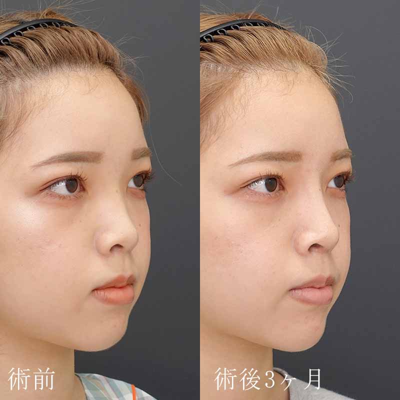 20231220_N44172_takee_nose-prosthesis-nasalseptum-extension001