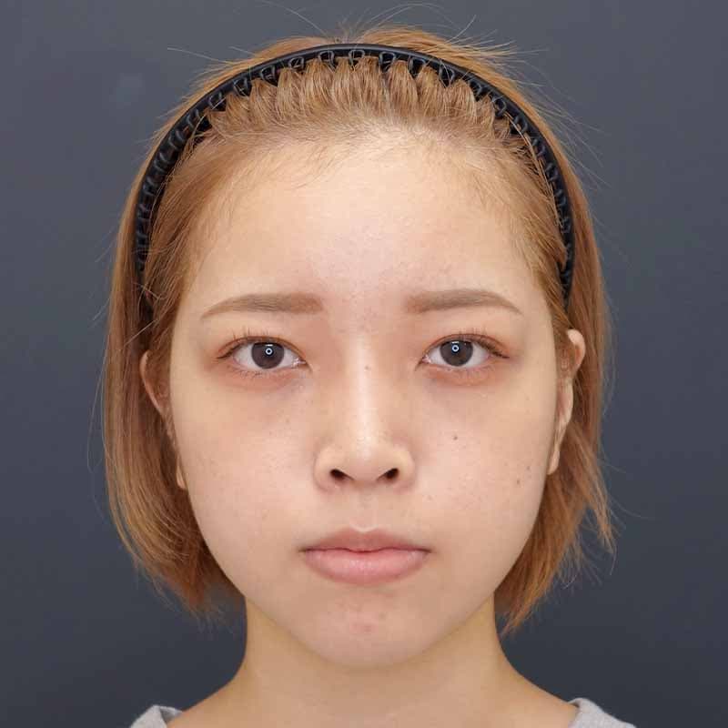 20231220_N44172_takee_nose-prosthesis-nasalseptum-extension02①After