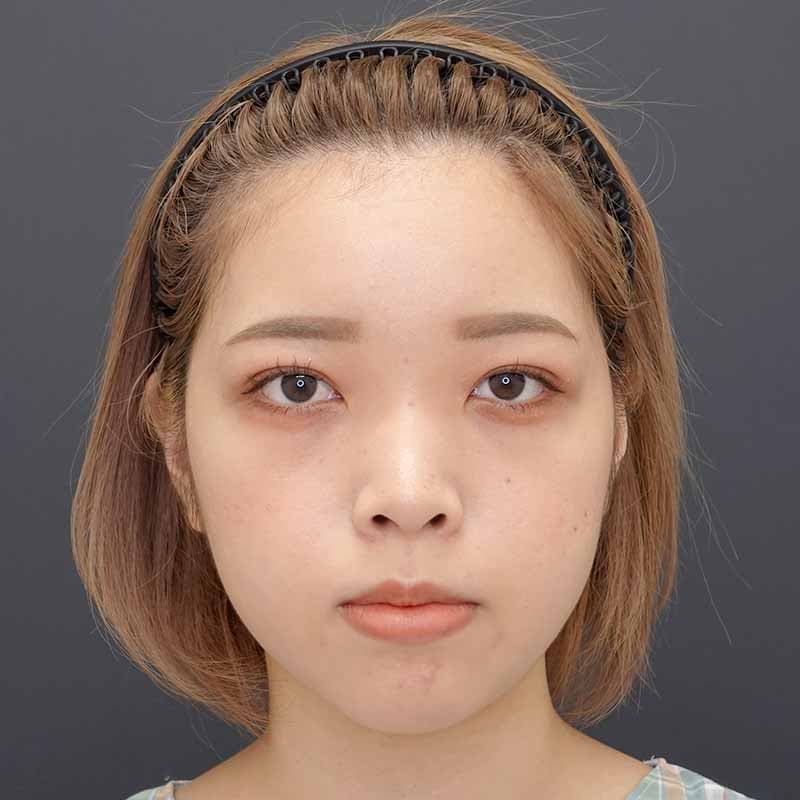 20231220_N44172_takee_nose-prosthesis-nasalseptum-extension02①Before