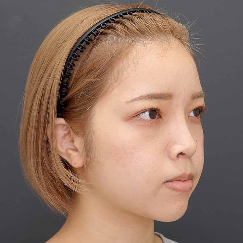 20231220_N44172_takee_nose-prosthesis-nasalseptum-extension02②After