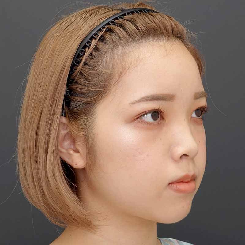 20231220_N44172_takee_nose-prosthesis-nasalseptum-extension02②Before