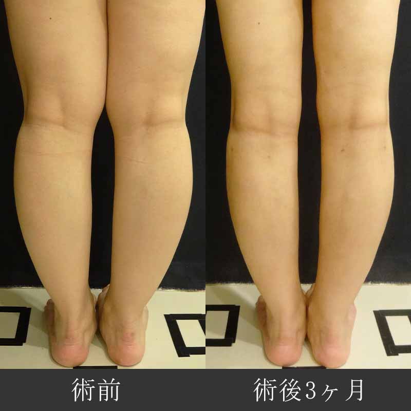 20230113_O-1618_calf-liposuction