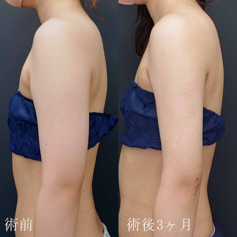20240114_N40462_nishikawa_arm-liposuction_O_part P縦