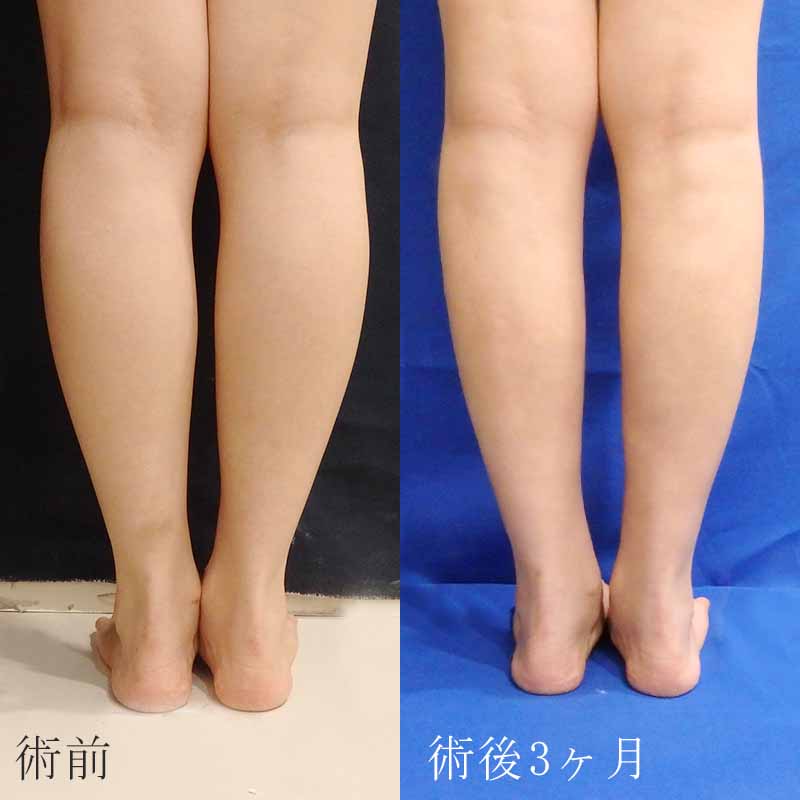 20240113_O6466_calf-liposuction