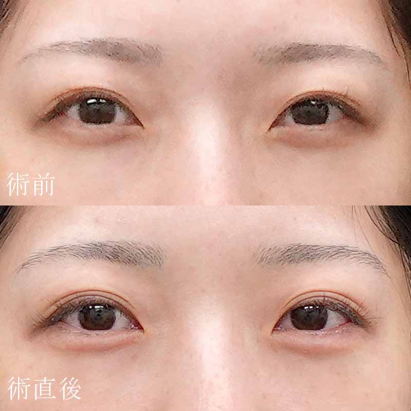 20240113_ozaki_tanaka_hyaluronic eye bags