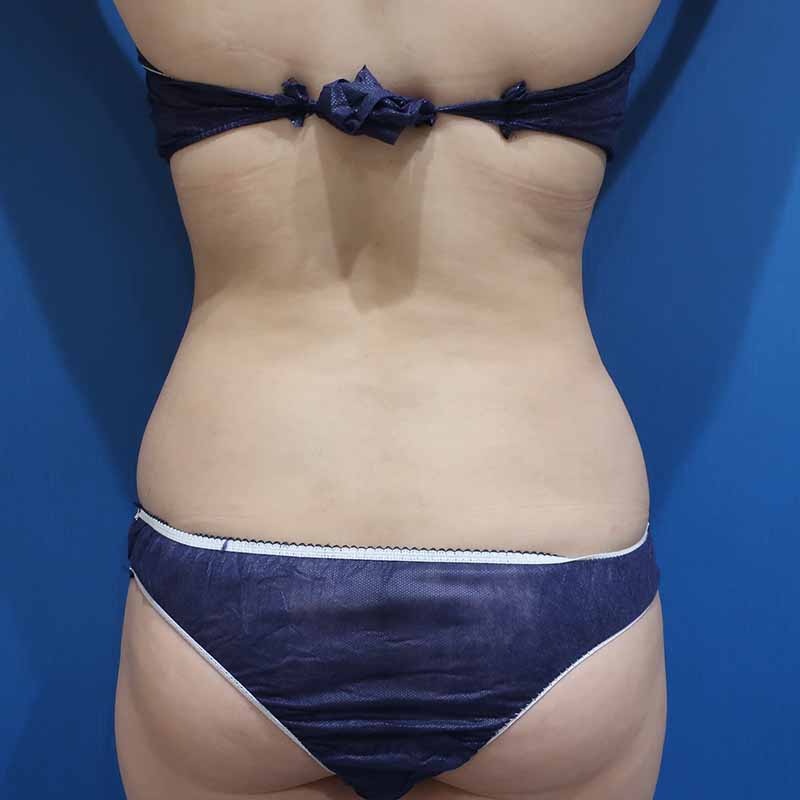 20240115_G18306_suzuki_stomach-liposuction_O_part 追加写真②After